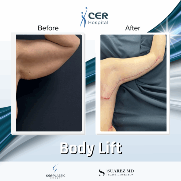 Body Lift - 0608 - Image 6