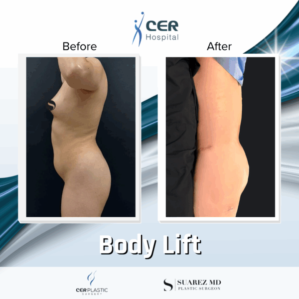 Body Lift - 22054 - Image 6