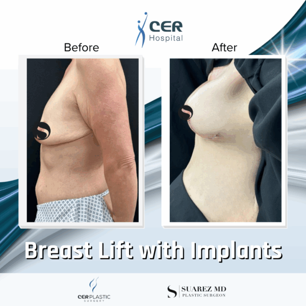 Breast Lift with Implants - 24054