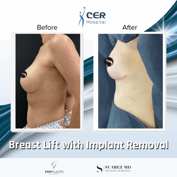 Breast Lift with Implant Removal - 14104 - Image 7