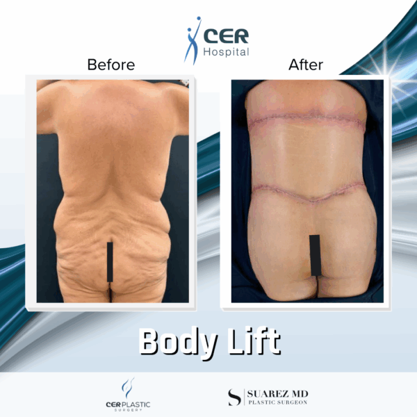 Body Lift - 31074 - Image 6