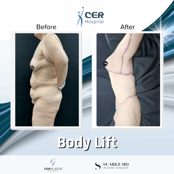 Body Lift - 24104 - Image 7