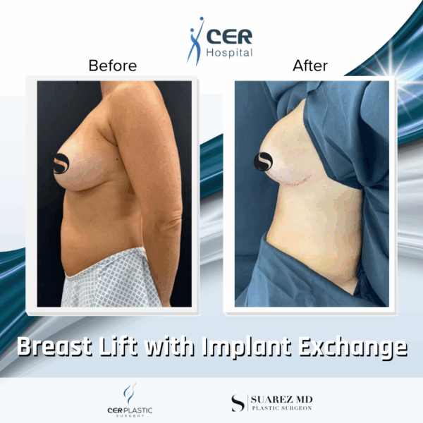Breast Lift with Implant Exchange - 28104
