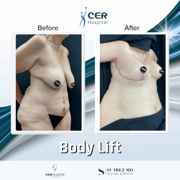 Body Lift - 10124 - Image 7