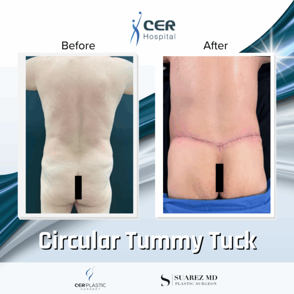 Circular Tummy Tuck - 11124 - Image 6