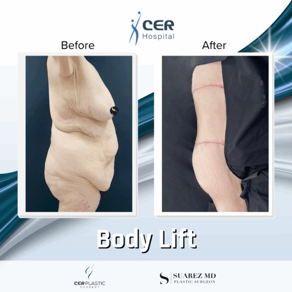 Body Lift - 7013 - Image 7