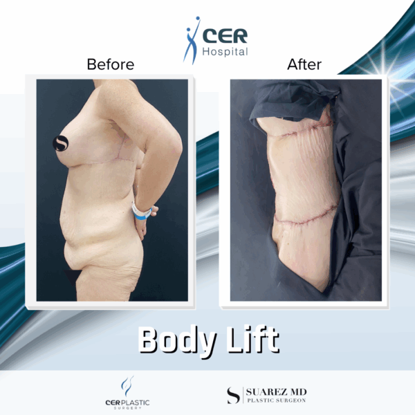 Body Lift - 8013 - Image 7