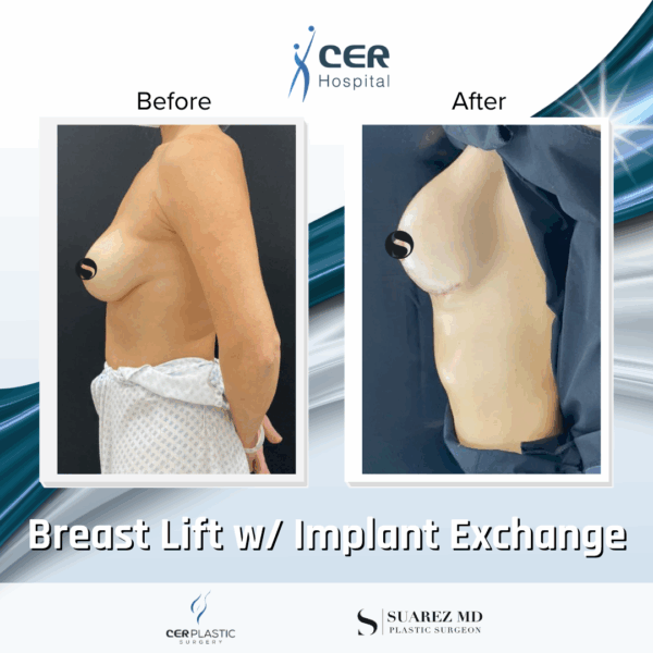 Breast Lift with Implant Exchange - 9013 - Image 6