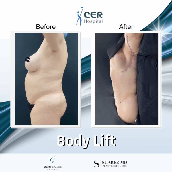 Body Lift - 11013 - Image 6