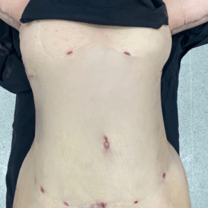 Body Lift – 11013