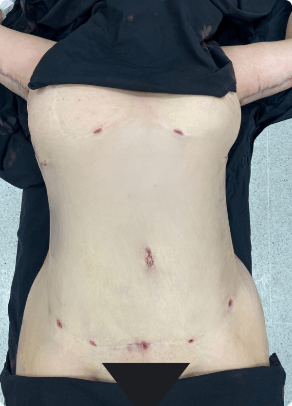 Body Lift - 11013 - Image 2