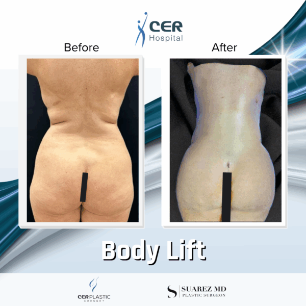 Body Lift - 16084 - Image 6