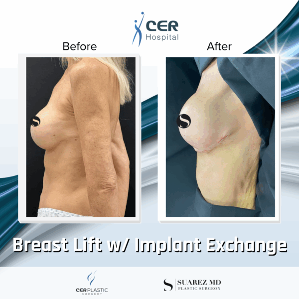 Breast Lift with Implants - 13013 - Image 7