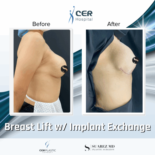 Breast Lift with Implant Exchange - 16013 - Image 6