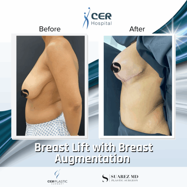 Breast Lift & Breast Augmentation - 16013 - Image 7