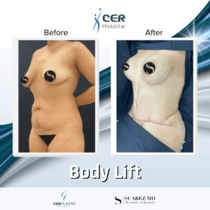 Body Lift – 18013