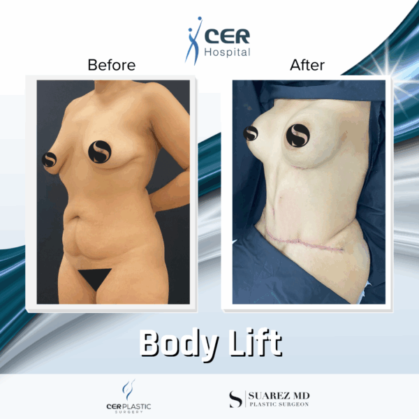 Body Lift - 18013