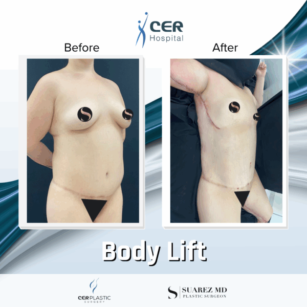 Body Lift - 20013 - Image 7