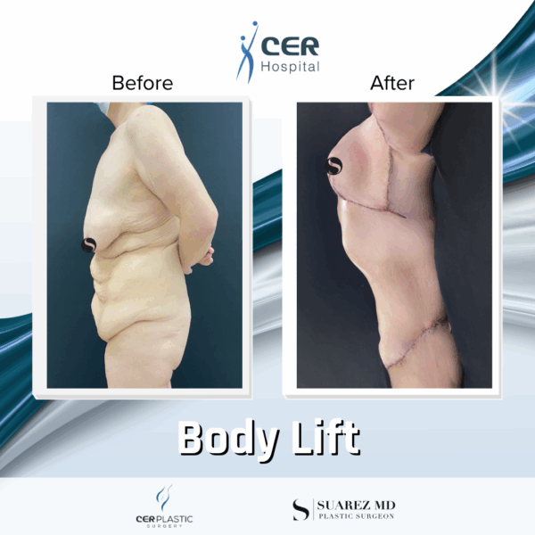 Body Lift - 20013 - Image 7