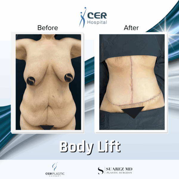 Body Lift - 23013 - Image 6