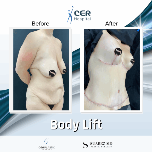 Body Lift - 13121 - Image 6
