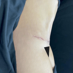Body Lift – 16084