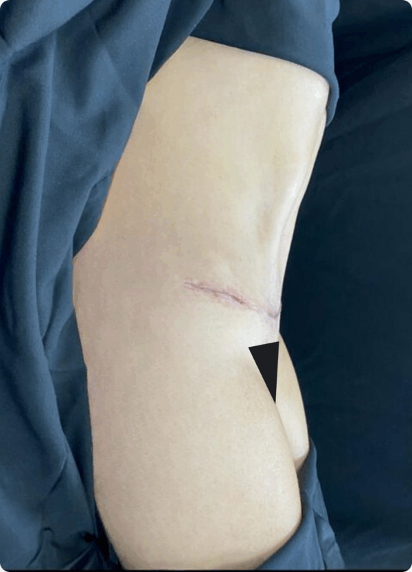 Body Lift - 16084 - Image 2