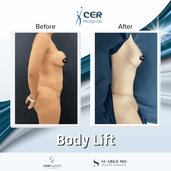 Body Lift - 26043 - Image 6