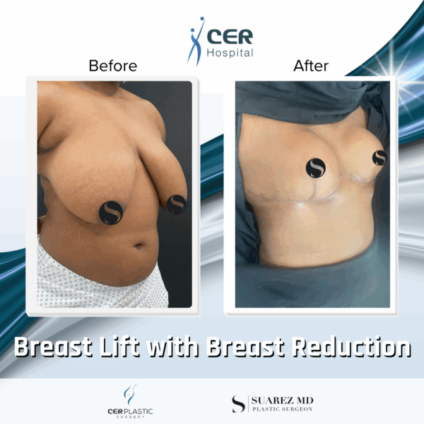 Breast Lift with Breast Reduction - 19043 - Image 6