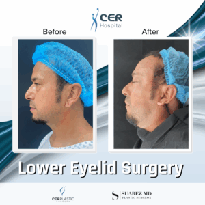 Lower Eyelid Surgery – 21043