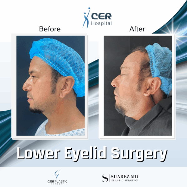 Lower Eyelid Surgery - 21043