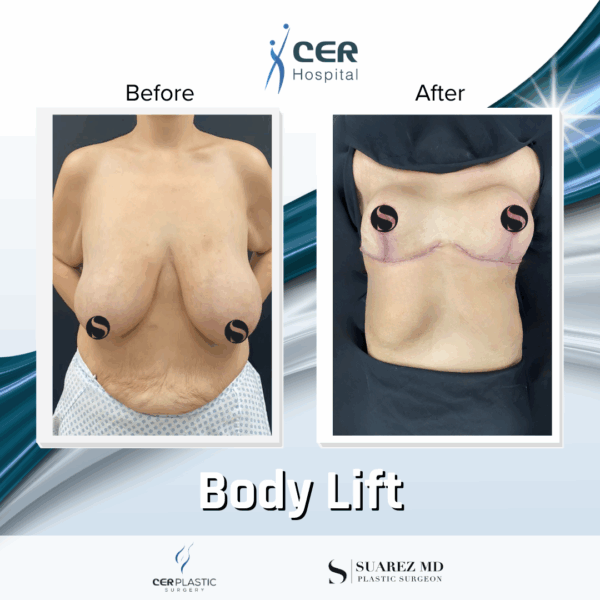 Body Lift - 10043 - Image 7