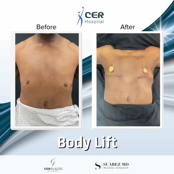 Body Lift - 19043 - Image 7