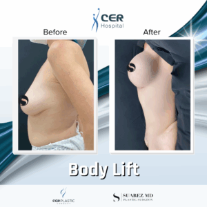 Circular Tummy Tuck – 3043