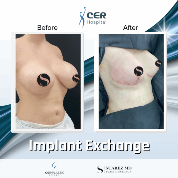 Implant Exchange - 3043 - Image 6