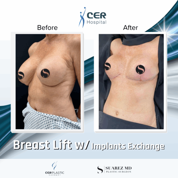 Breast Lift with Implant Exchange - 26084
