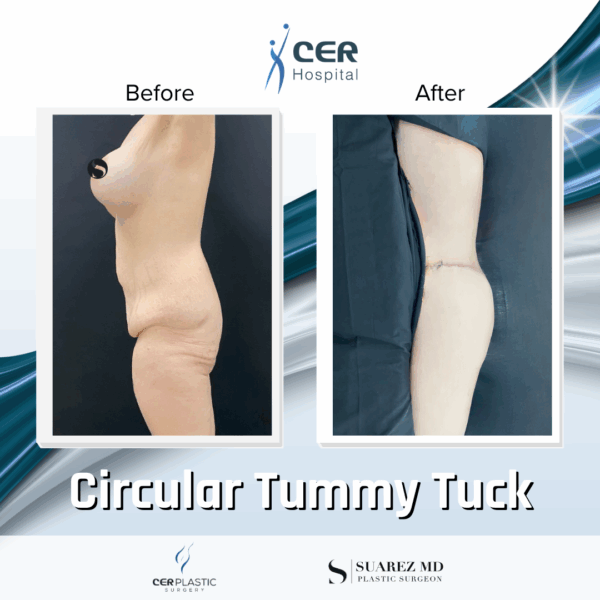 Circular Tummy Tuck - 3043 - Image 6