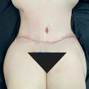 Circular Tummy Tuck – 3043