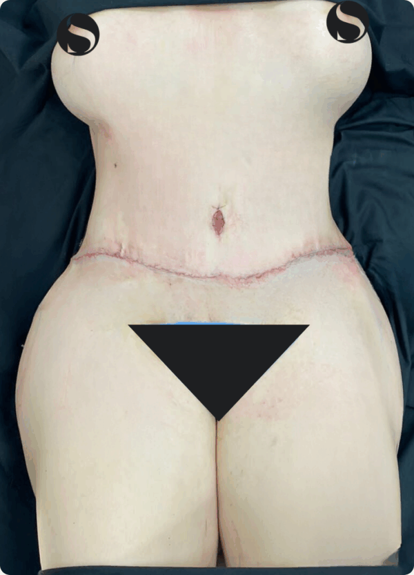 Circular Tummy Tuck - 3043 - Image 2