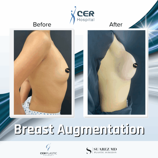Breast Augmentation - 31053 - Image 6