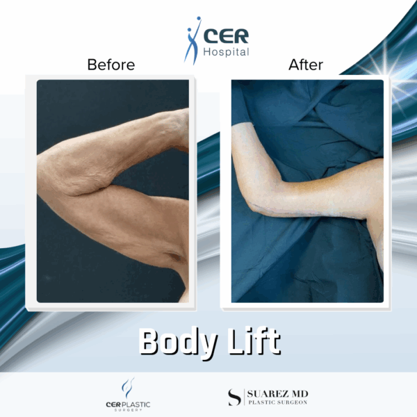 Body Lift - 18094