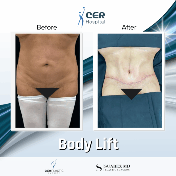 Body Lift - 2104