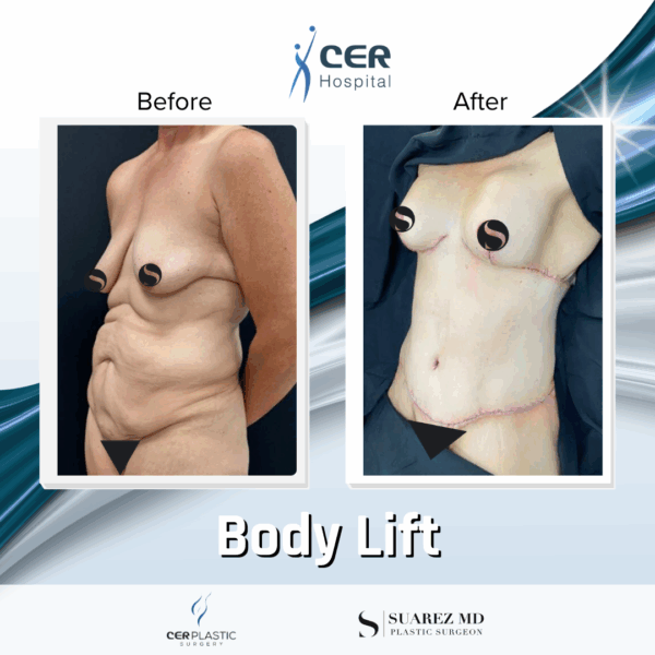 Body Lift - 9104 - Image 10
