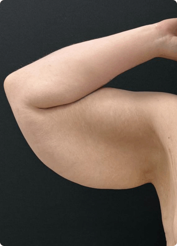 Arm Lift - 24074 - Image 3