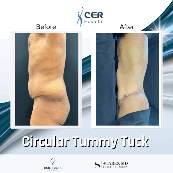 Circular Tummy Tuck - 11104