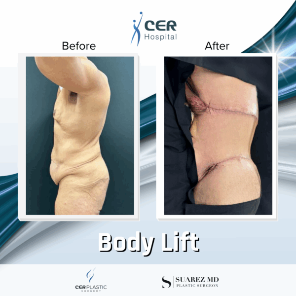 Body Lift - 3074 - Image 7