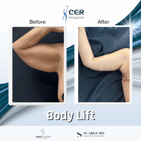 Body Lift - 0608 - Image 7