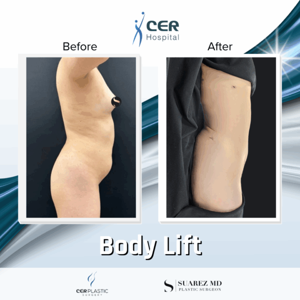 Body Lift - 22054 - Image 7