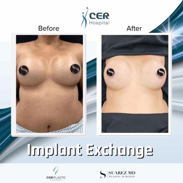 Implant Exchange - 24054