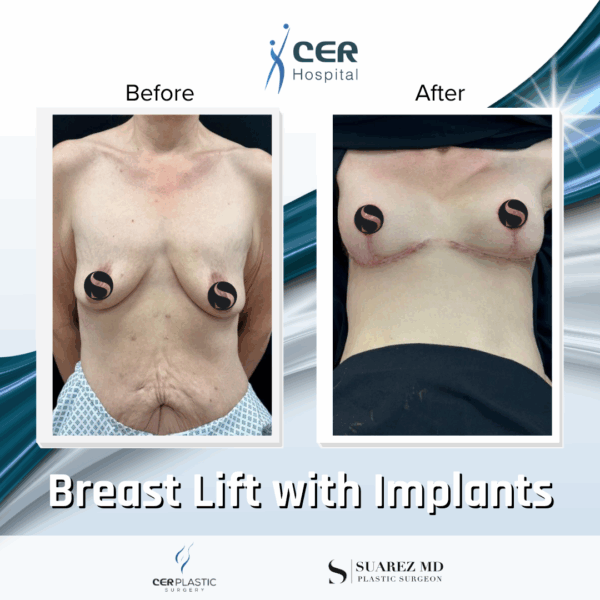Breast Lift with Implants - 24054 - Image 7